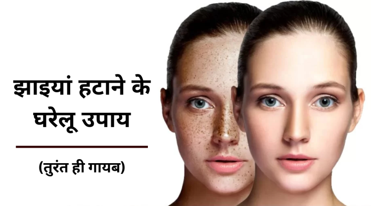 Jhaiyaan Hataane ke Ghareloo Upaay : झाइयां हटाने के घरेलू उपाय- तुरंत ही गायब |