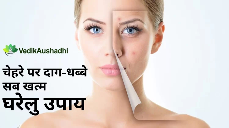 How to Glow Face Naturally :चेहरे के दाग धब्बे हटाने के घरेलु उपाय|