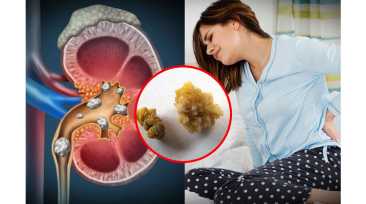 pet ki pathari ke gharelu upay