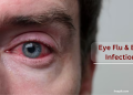 Eye Flu